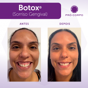 Botox ®: Fotos Antes e Depois sorriso gengival