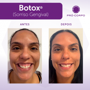 Toxina Botulínica - Fotos Antes e Depois