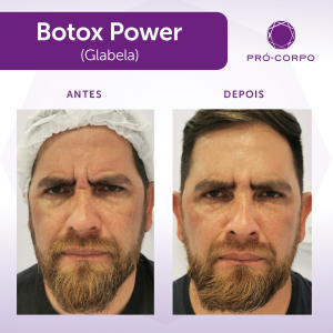 Botox ®: Fotos Antes e Depois