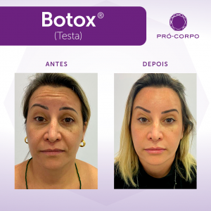 Botox ®: Fotos Antes e Depois