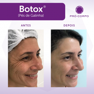 Toxina Botulínica - Fotos Antes e Depois