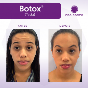 Botox ®: Fotos Antes e Depois