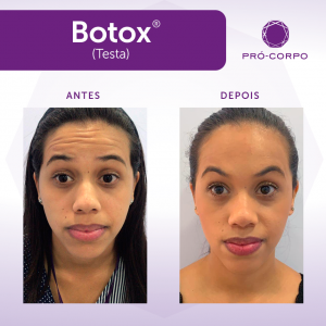 Toxina Botulínica - Fotos Antes e Depois