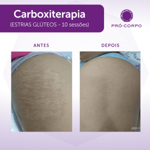 Carboxiterapia Antes e Depois