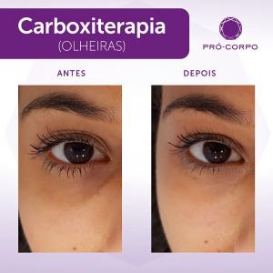 Carboxiterapia Antes e Depois