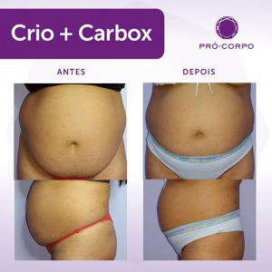 Carboxiterapia Antes e Depois