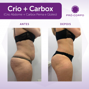 Carboxiterapia Antes e Depois