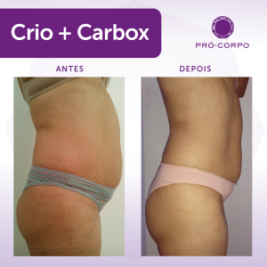 Carboxiterapia Antes e Depois