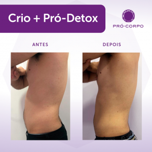 Massagem Pró-Detox Fotos Antes e Depois