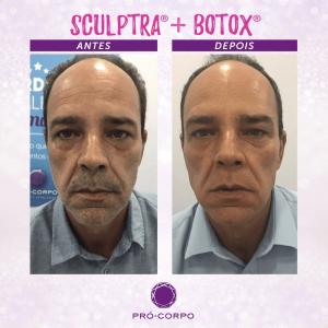 Flacidez Facial - Fotos Antes e Depois