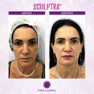 Flacidez Facial - Fotos Antes e Depois