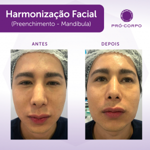 preenchimento-mandibula-antes-depois