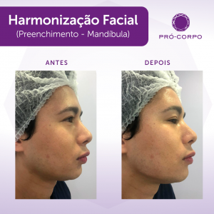 preenchimento-mandibula-antes-depois