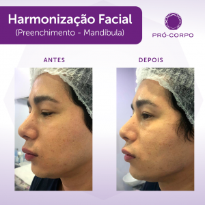 preenchimento-mandibula-antes-depois