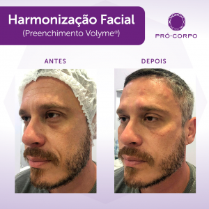 harmonização-facial-masculina