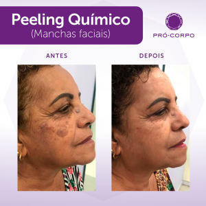 Manchas Faciais: Fotos de Antes e Depois