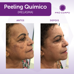 peeling-químico-melasma