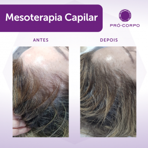 Mesoterapia Capilar na Pró-Corpo