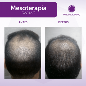 Mesoterapia Capilar na Pró-Corpo