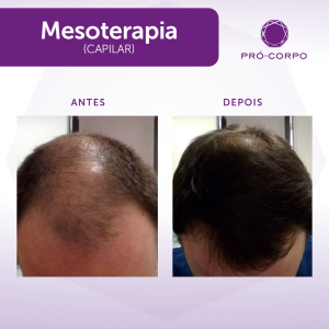 Mesoterapia Capilar na Pró-Corpo