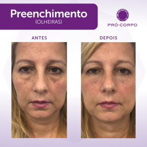 Preenchimento Fotos Antes e Depois