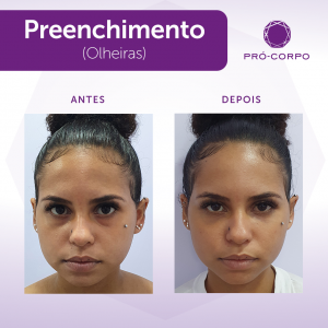 Preenchimento Olheira Fotos  Antes e Depois
