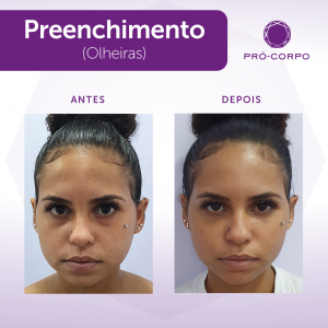 Preenchimento Fotos Antes e Depois