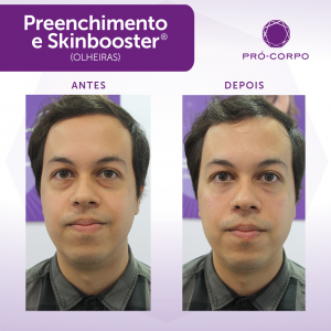 Skinbooster Antes e Depois