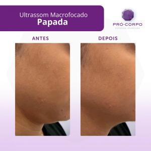 papada