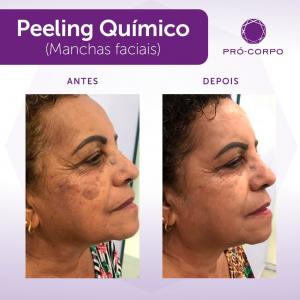 Peeling Químico Fotos Antes e Depois