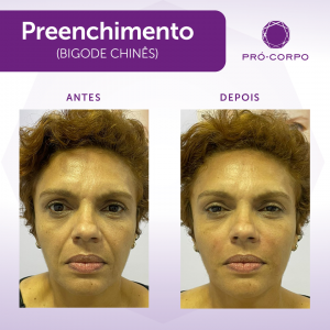 Linhas de Expressão: Fotos de Antes e Depois