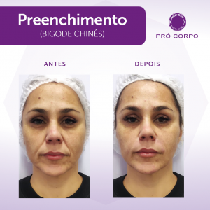 Preenchimento Fotos Antes e Depois