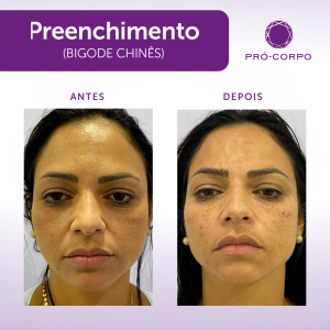 Preenchimento Bigode Chines Fotos  Antes e Depois