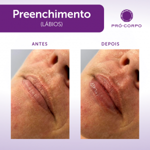 Preenchimento Labial Fotos  Antes e Depois