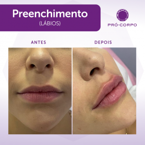 Preenchimento Fotos Antes e Depois