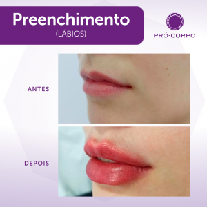 Preenchimento Labial Fotos Antes e Depois 1 ml