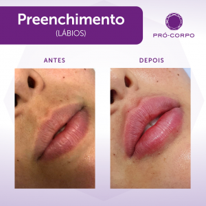 Preenchimento Labial Fotos  Antes e Depois