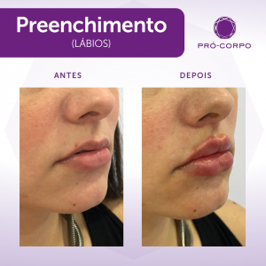 Preenchimento Labial Fotos Antes e Depois 1 ml