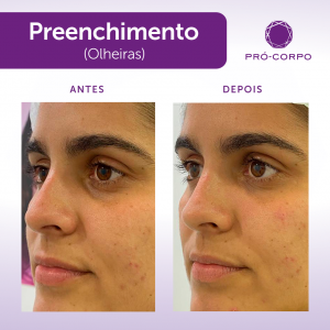 Preenchimento Fotos Antes e Depois