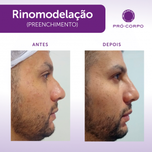 Rinomodelação Pró-Corpo Estética Avançada