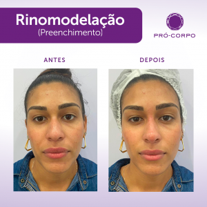 Rinomodelação Pró-Corpo Estética Avançada