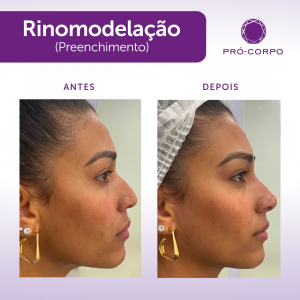 Rinomodelação Pró-Corpo Estética Avançada