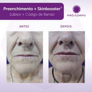 Skinbooster Antes e Depois