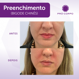 Bigode Chinês - Fotos Antes e Depois