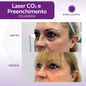 Laser CO2 Fracionado Fotos Antes e Depois