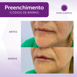 Preenchimento Bigode Codigo de Barras Fotos  Antes e Depois