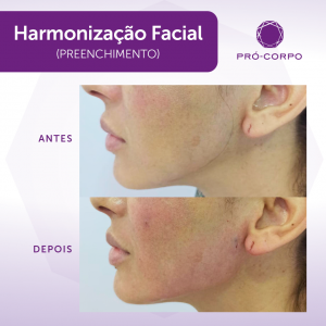 Harmonização Facial