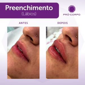 Preenchimento Labial Fotos Antes e Depois 1 ml