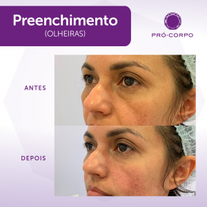 Preenchimento Fotos Antes e Depois