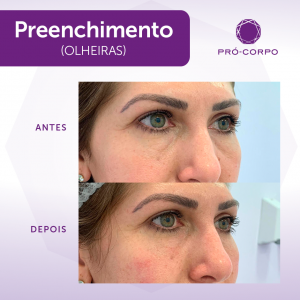 Preenchimento Fotos Antes e Depois